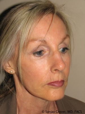 Facelift Before and After 34 | Sanjay Grover MD FACS