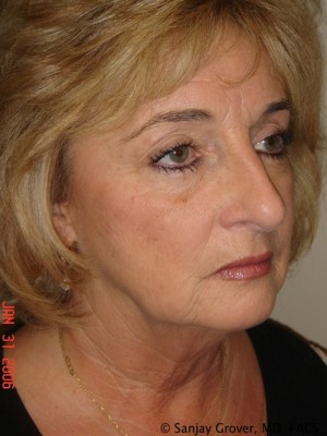 Facelift Before and After 16 | Sanjay Grover MD FACS