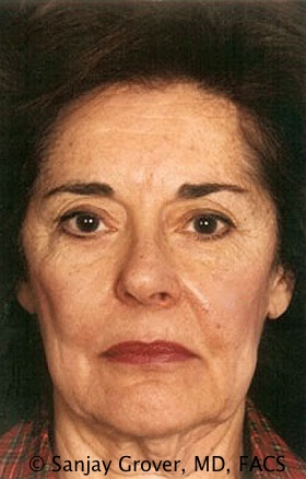 Facelift Before and After 30 | Sanjay Grover MD FACS