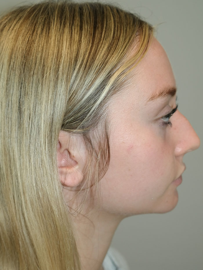 Rhinoplasty Before and After 02 | Sanjay Grover MD FACS
