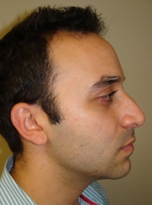 Rhinoplasty Before and After 22 | Sanjay Grover MD FACS