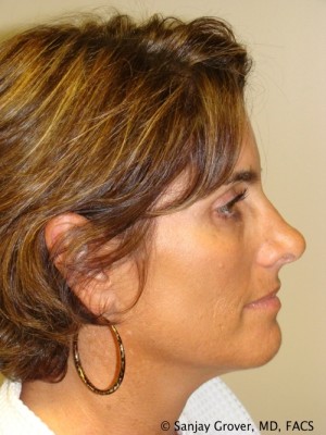 Rhinoplasty Before and After 51 | Sanjay Grover MD FACS