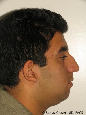 Rhinoplasty Before and After 15 | Sanjay Grover MD FACS