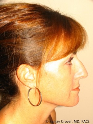 Rhinoplasty Before and After 42 | Sanjay Grover MD FACS