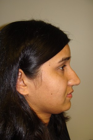 Rhinoplasty Before and After 07 | Sanjay Grover MD FACS
