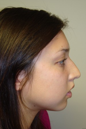 Rhinoplasty Before and After 49 | Sanjay Grover MD FACS