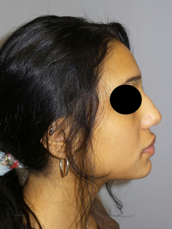 Rhinoplasty Before and After 26 | Sanjay Grover MD FACS