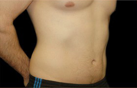 Coolsculpting Before and After 01 | Sanjay Grover MD FACS