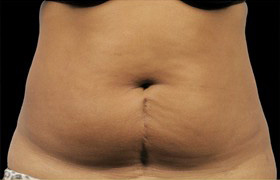 Coolsculpting Before and After 24 | Sanjay Grover MD FACS
